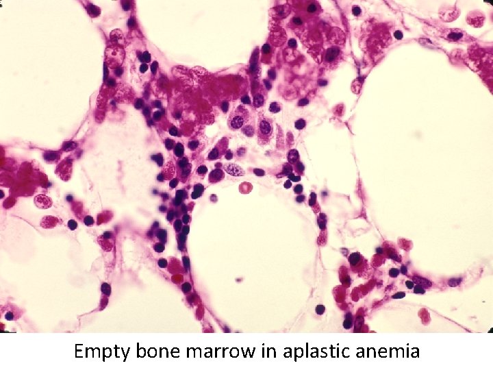 Empty bone marrow in aplastic anemia 