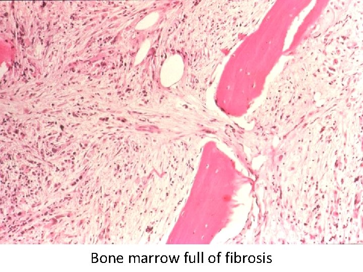 Bone marrow full of fibrosis 
