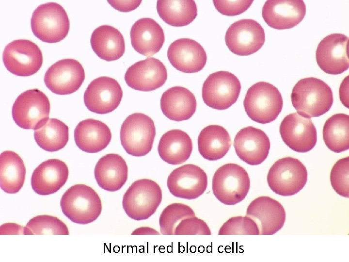 Normal red blood cells 