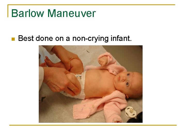 Barlow Maneuver n Best done on a non-crying infant. 