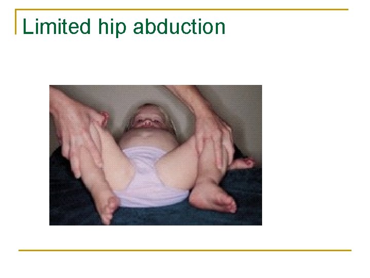 Limited hip abduction 