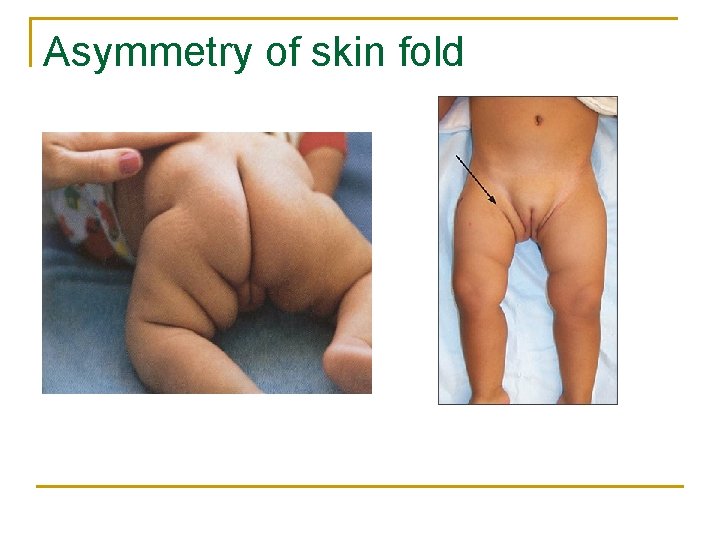Asymmetry of skin fold 