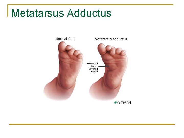 Metatarsus Adductus 