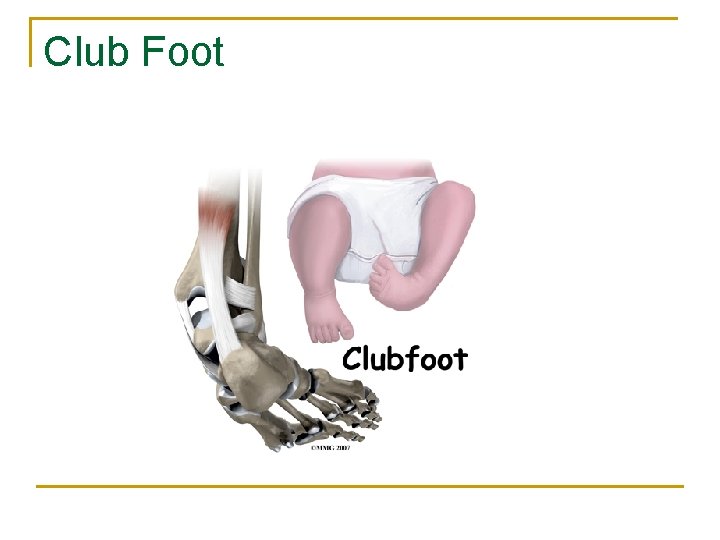 Club Foot 