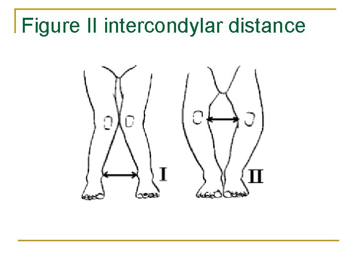 Figure II intercondylar distance 