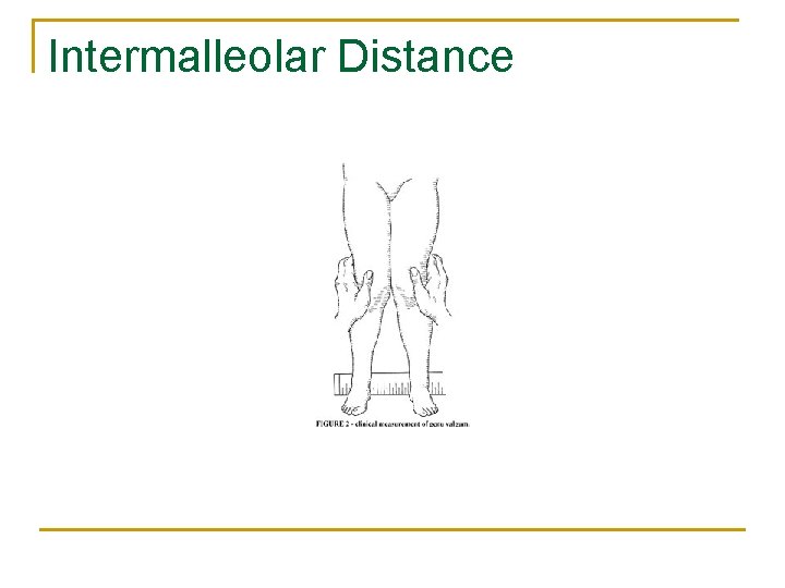 Intermalleolar Distance 