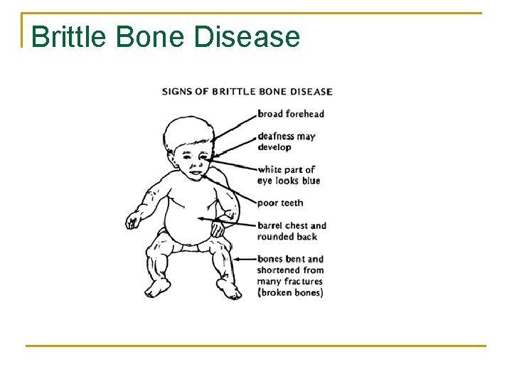 Brittle Bone Disease 