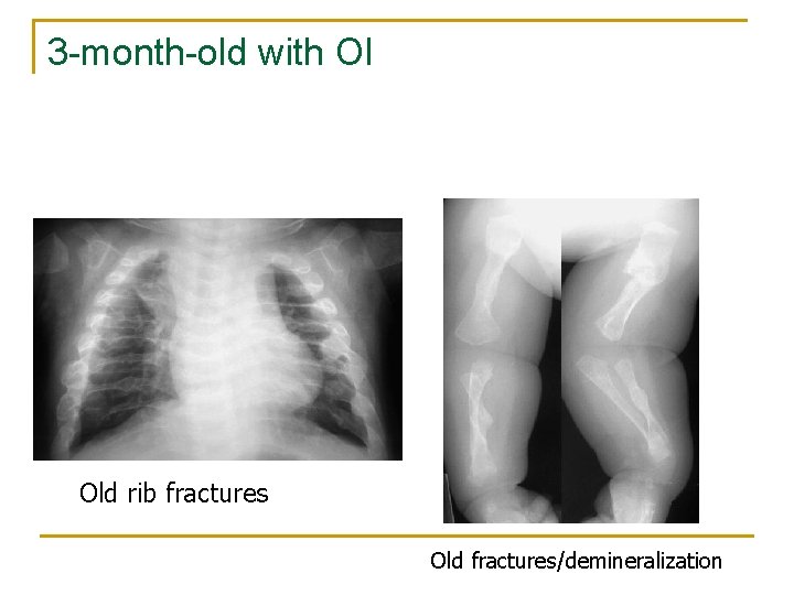 3 -month-old with OI Old rib fractures Old fractures/demineralization 