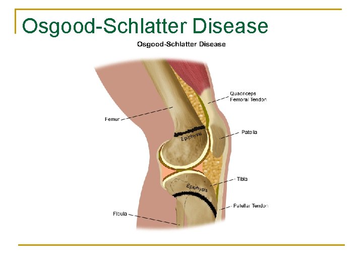 Osgood-Schlatter Disease 