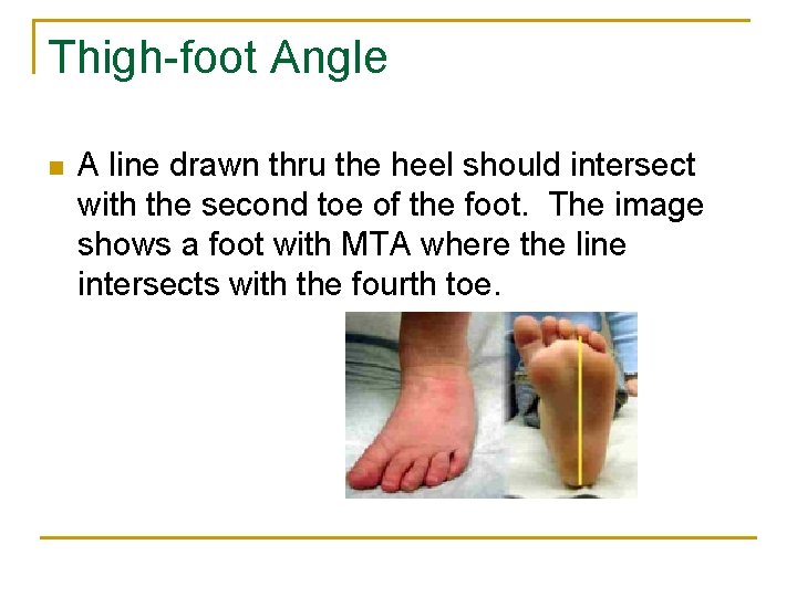 Thigh-foot Angle n A line drawn thru the heel should intersect with the second