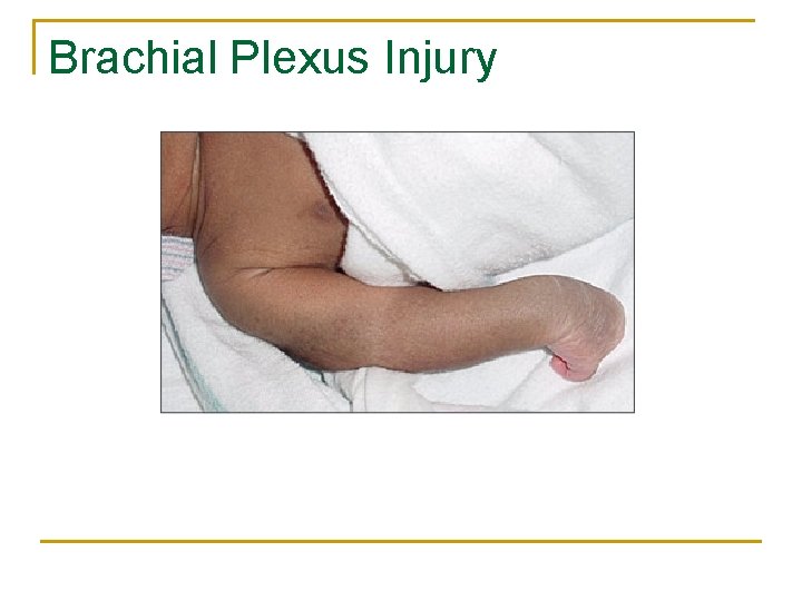 Brachial Plexus Injury 