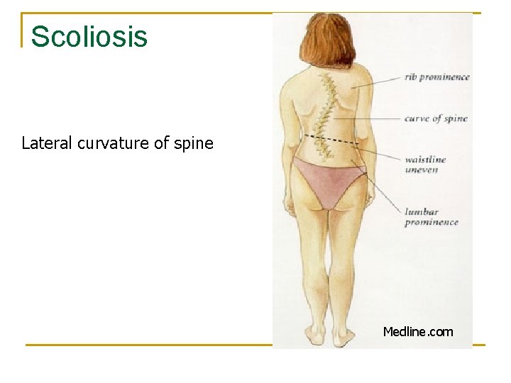 Scoliosis Lateral curvature of spine Medline. com 