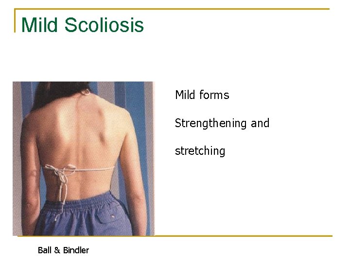 Mild Scoliosis Mild forms Strengthening and stretching Ball & Bindler 