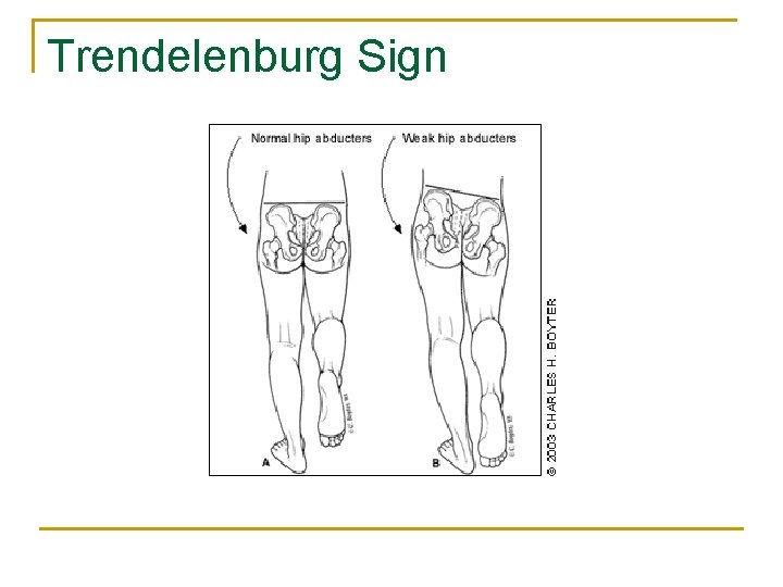 Trendelenburg Sign 