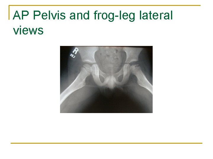 AP Pelvis and frog-leg lateral views 