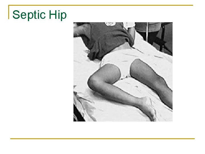 Septic Hip 