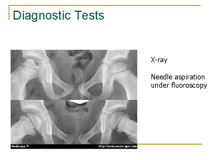 Diagnostic Tests X-ray Needle aspiration under fluoroscopy 