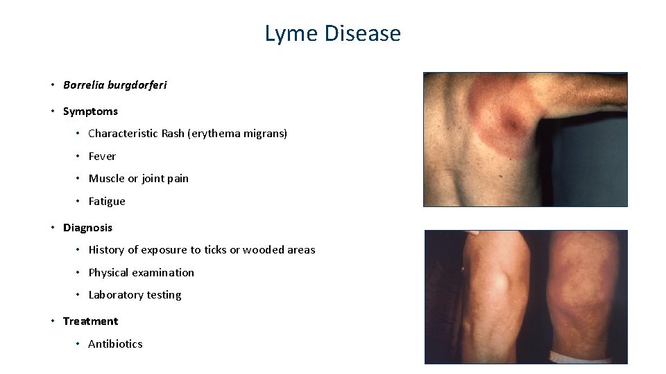 Lyme Disease • Borrelia burgdorferi • Symptoms • Characteristic Rash (erythema migrans) • Fever