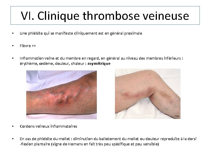 VI. Clinique thrombose veineuse • Une phlébite qui se manifeste cliniquement est en général