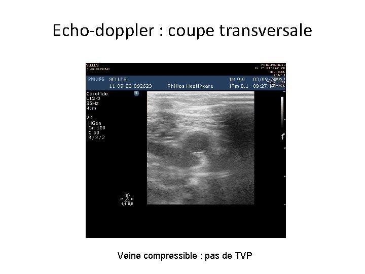Echo-doppler : coupe transversale Veine compressible : pas de TVP 