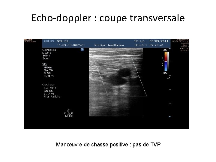 Echo-doppler : coupe transversale Manœuvre de chasse positive : pas de TVP 