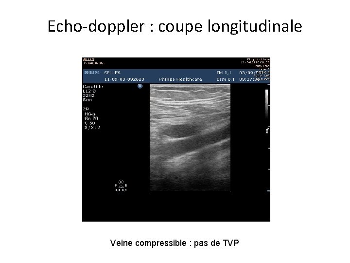 Echo-doppler : coupe longitudinale Veine compressible : pas de TVP 