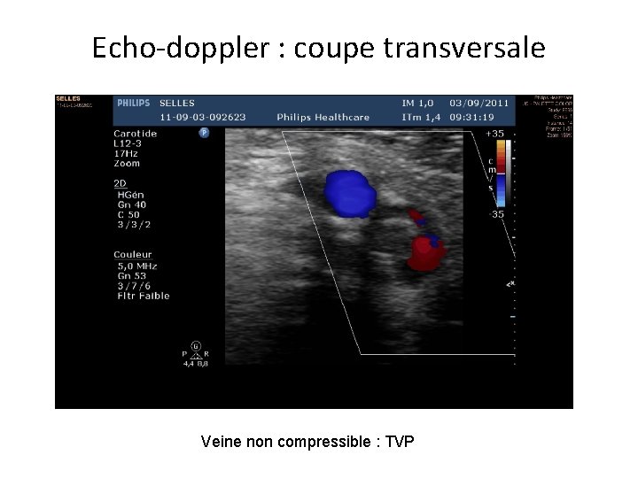 Echo-doppler : coupe transversale Veine non compressible : TVP 