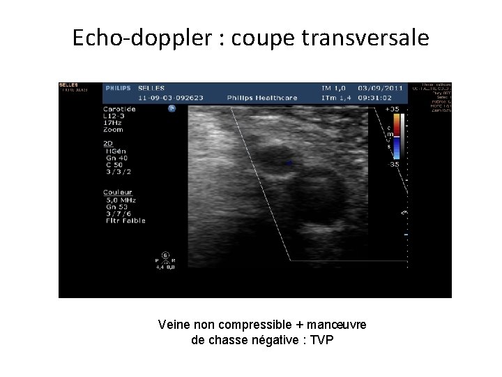 Echo-doppler : coupe transversale Veine non compressible + manœuvre de chasse négative : TVP