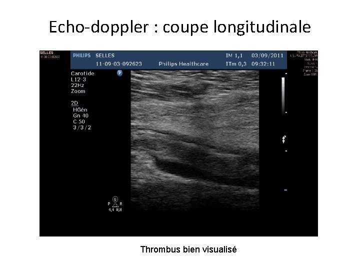 Echo-doppler : coupe longitudinale Thrombus bien visualisé 