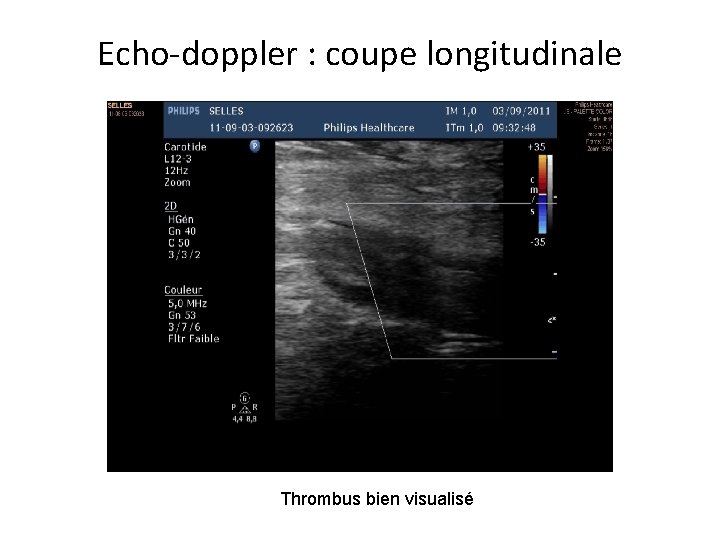 Echo-doppler : coupe longitudinale Thrombus bien visualisé 