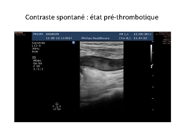 Contraste spontané : état pré-thrombotique 