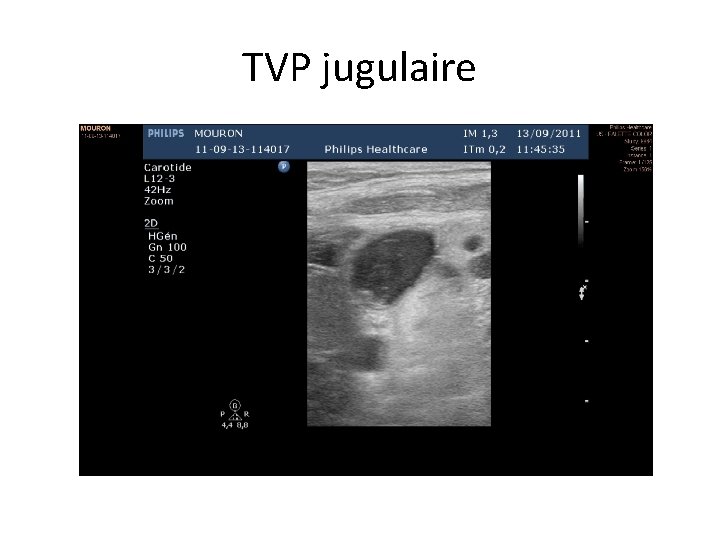 TVP jugulaire 