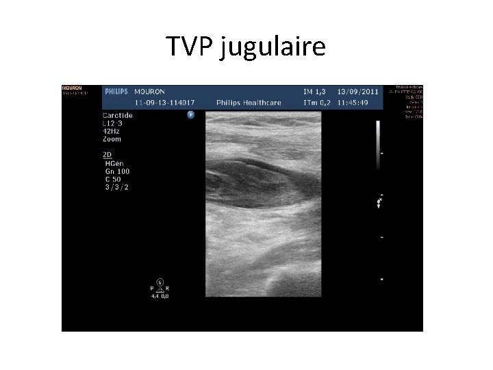 TVP jugulaire 