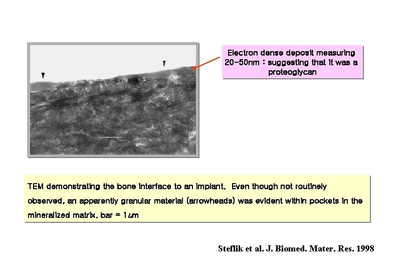 Electron dense deposit measuring 20 -50 nm : suggesting that it was a proteoglycan