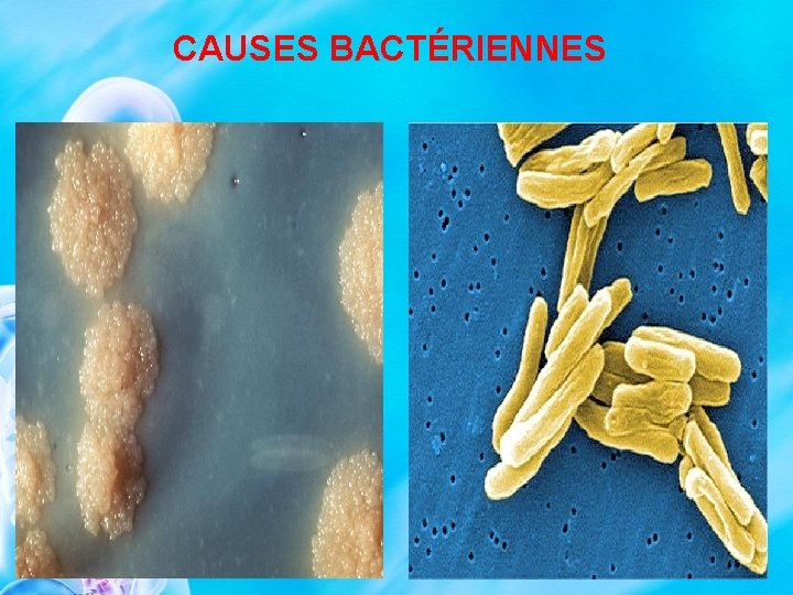 CAUSES BACTÉRIENNES 