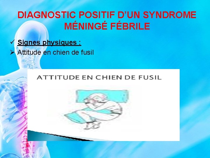 DIAGNOSTIC POSITIF D’UN SYNDROME MÉNINGÉ FÉBRILE ü Signes physiques : Ø Attitude en chien