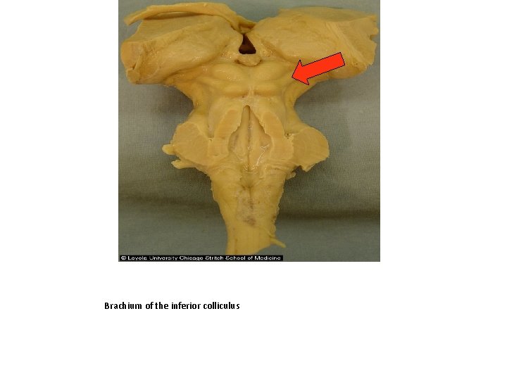 Brachium of the inferior colliculus 