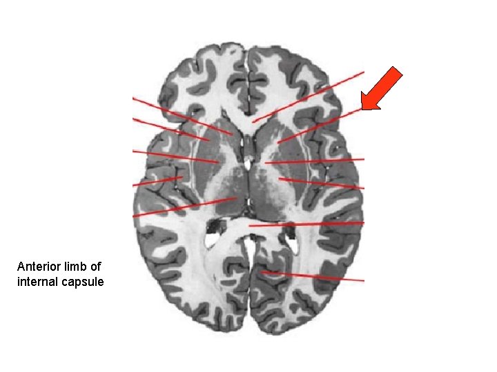 Anterior limb of internal capsule 