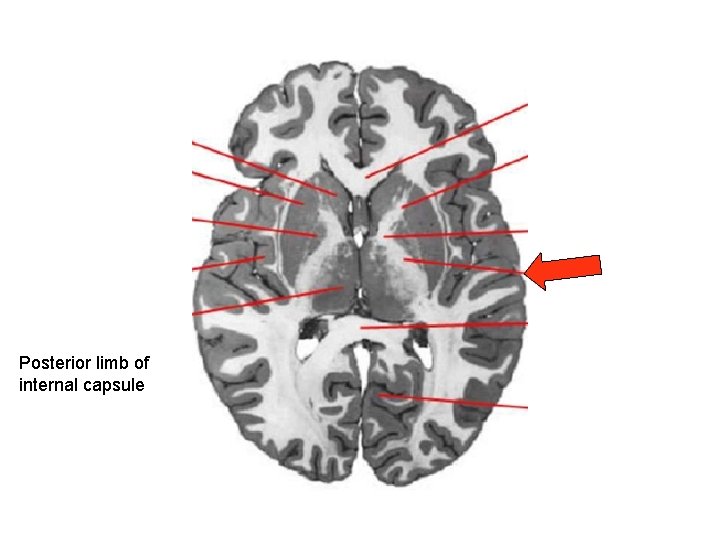 Posterior limb of internal capsule 