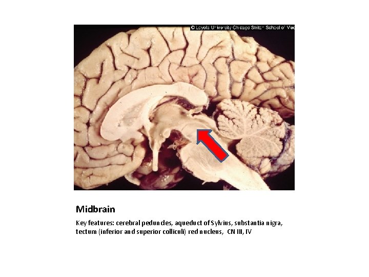 Midbrain Key features: cerebral peduncles, aqueduct of Sylvius, substantia nigra, tectum (inferior and superior