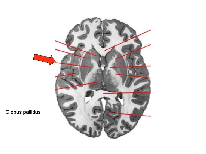 Globus pallidus 