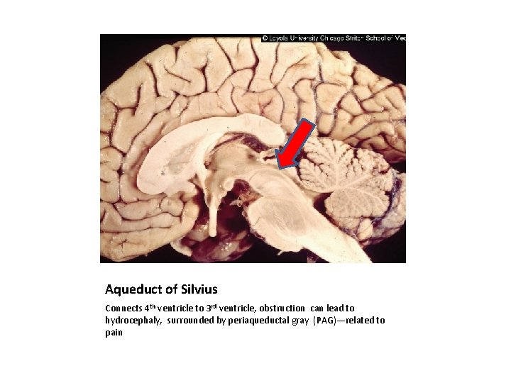 Aqueduct of Silvius Connects 4 th ventricle to 3 rd ventricle, obstruction can lead