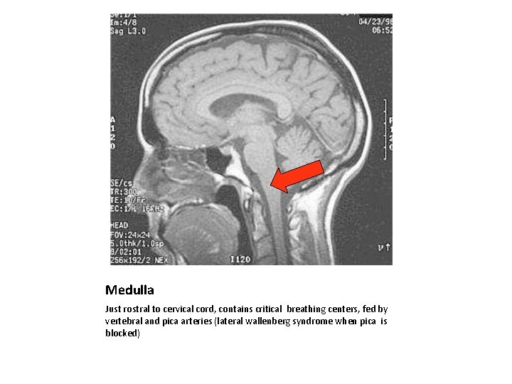 Medulla Just rostral to cervical cord, contains critical breathing centers, fed by vertebral and