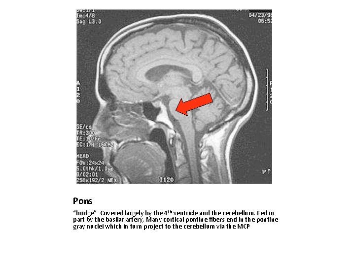 Pons “bridge” Covered largely by the 4 th ventricle and the cerebellum. Fed in