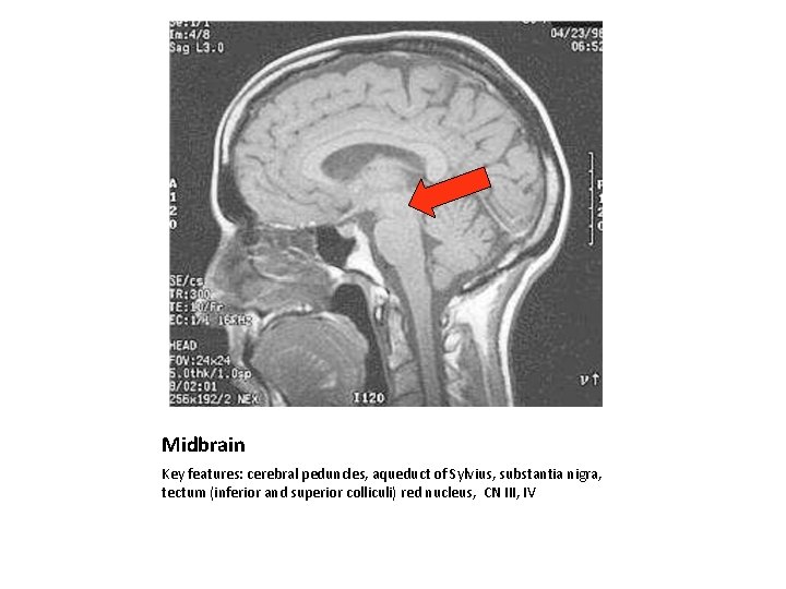 Midbrain Key features: cerebral peduncles, aqueduct of Sylvius, substantia nigra, tectum (inferior and superior