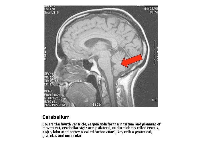 Cerebellum Covers the fourth ventricle, responsible for the initiation and planning of movement, cerebellar