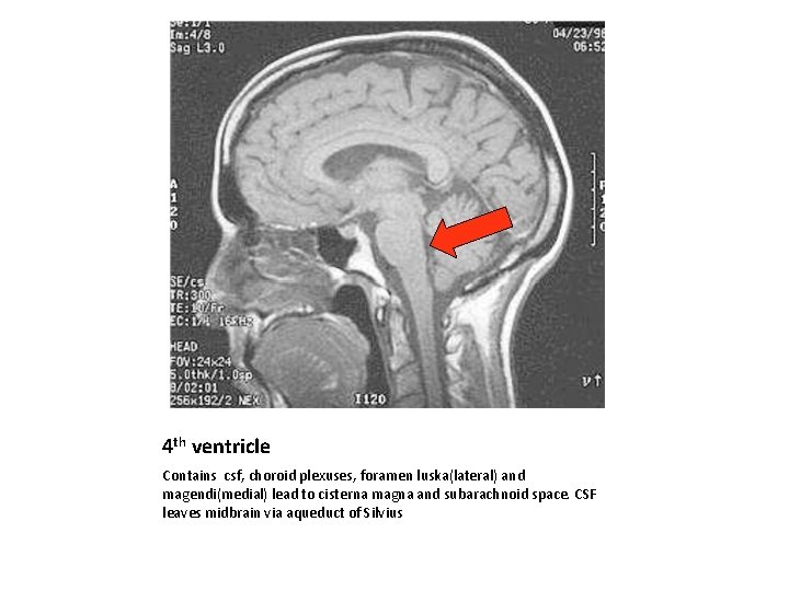 4 th ventricle Contains csf, choroid plexuses, foramen luska(lateral) and magendi(medial) lead to cisterna