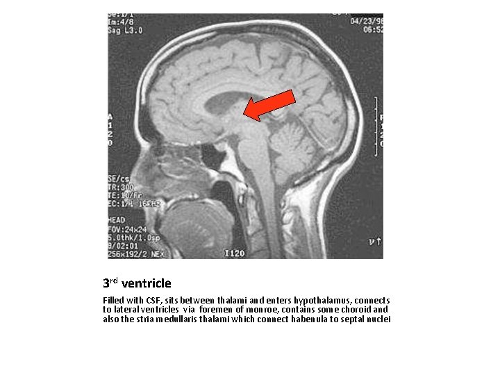 3 rd ventricle Filled with CSF, sits between thalami and enters hypothalamus, connects to
