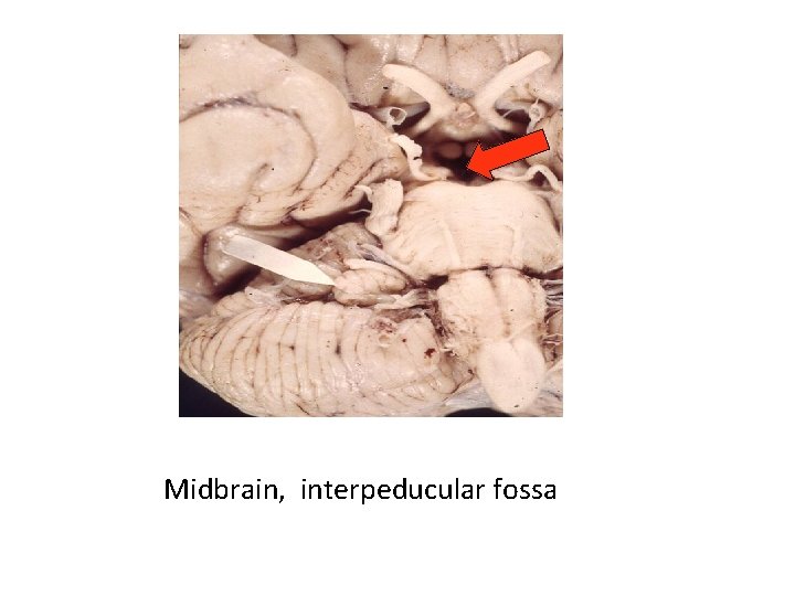 Midbrain, interpeducular fossa 