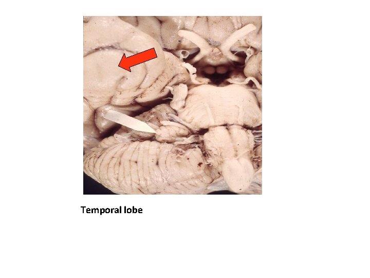 Temporal lobe 